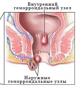 Лечение геморроя в МЦ «Оксфорд Медикал Днепропетровск»