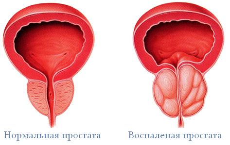Лечение простатита в МЦ «Оксфорд Медикал Днепропетровск»