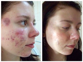 До и после лечения акне в МЦ «Оксфорд Медикал Днепропетровск»